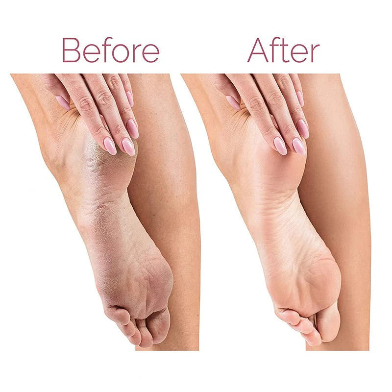 Electric Pedicure Foot File Callus Remover|Erase Rough Dry Skin